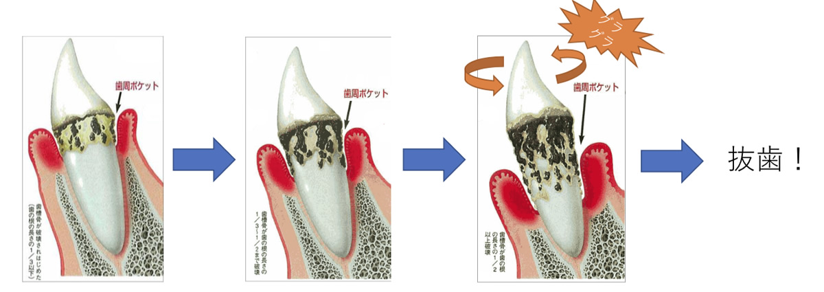 当院の虫歯治療