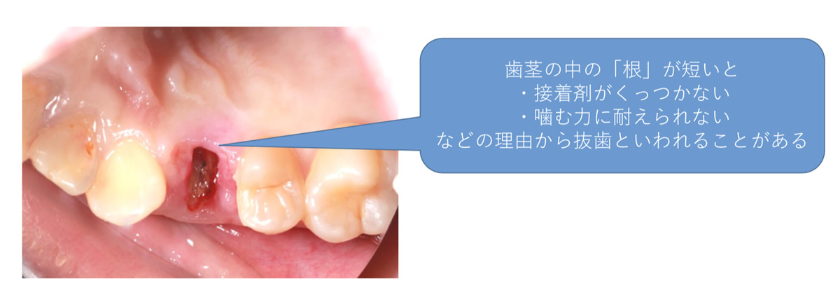 当院の虫歯治療