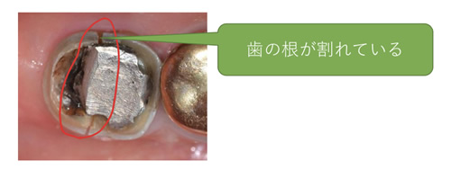 当院の虫歯治療