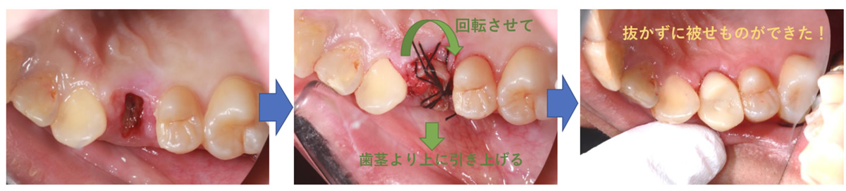 当院の虫歯治療