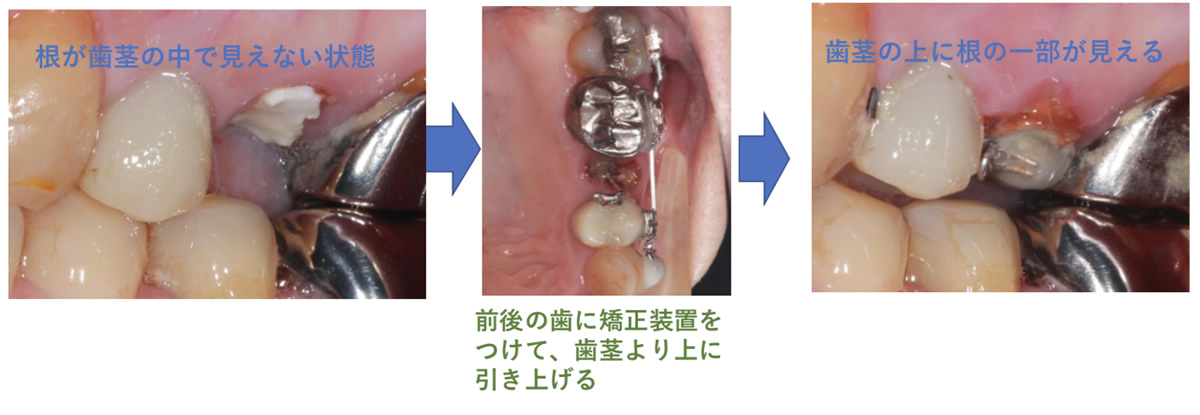 当院の虫歯治療