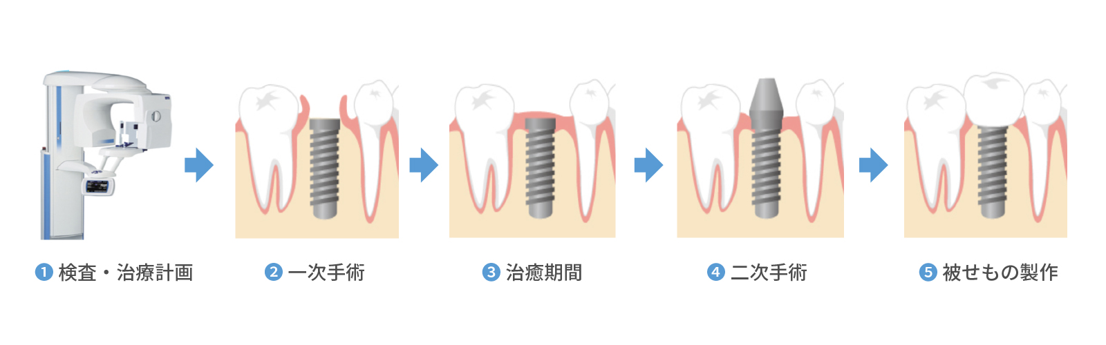 インプラント治療の流れ