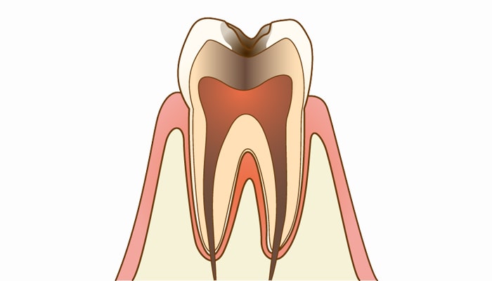 C3：歯髄(神経)に達した虫歯 