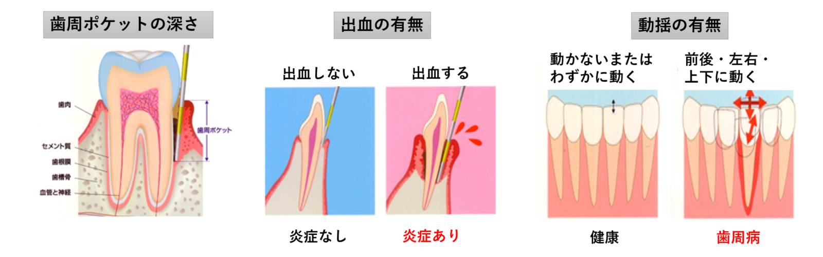 歯茎（歯周病）の検査