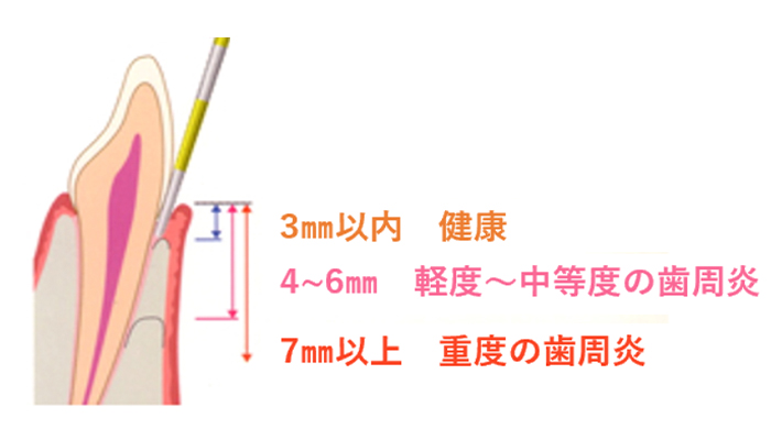歯周ポケットの深さの違いによる状態の目安