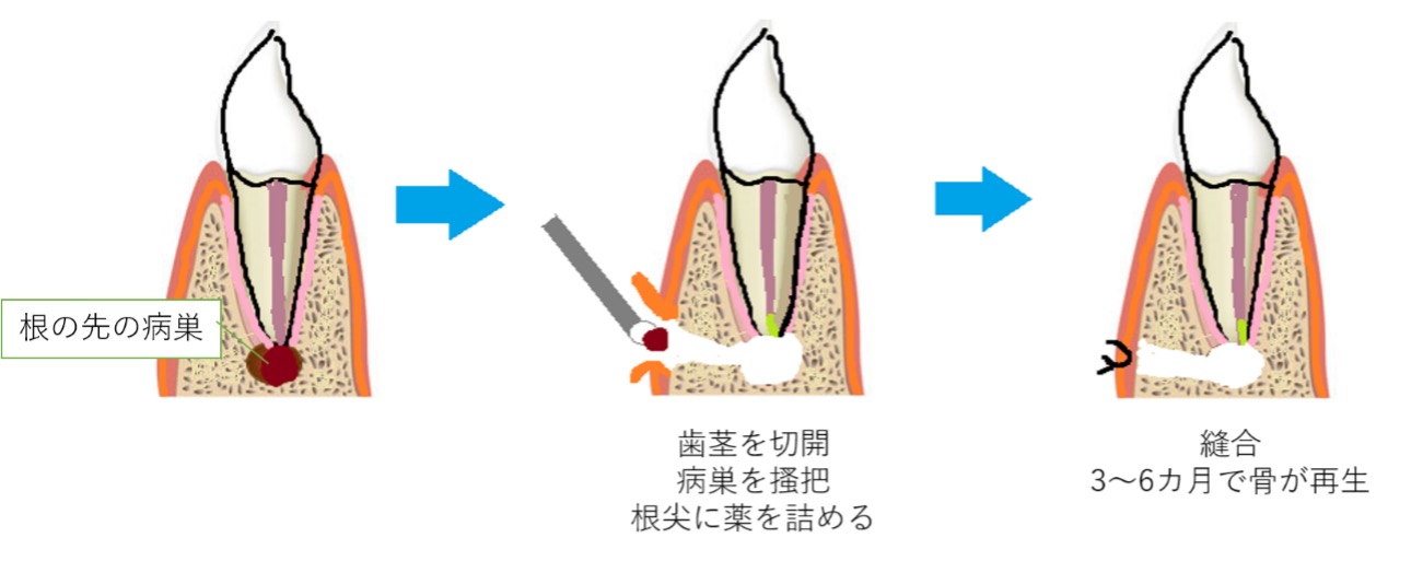 外科的歯内療法