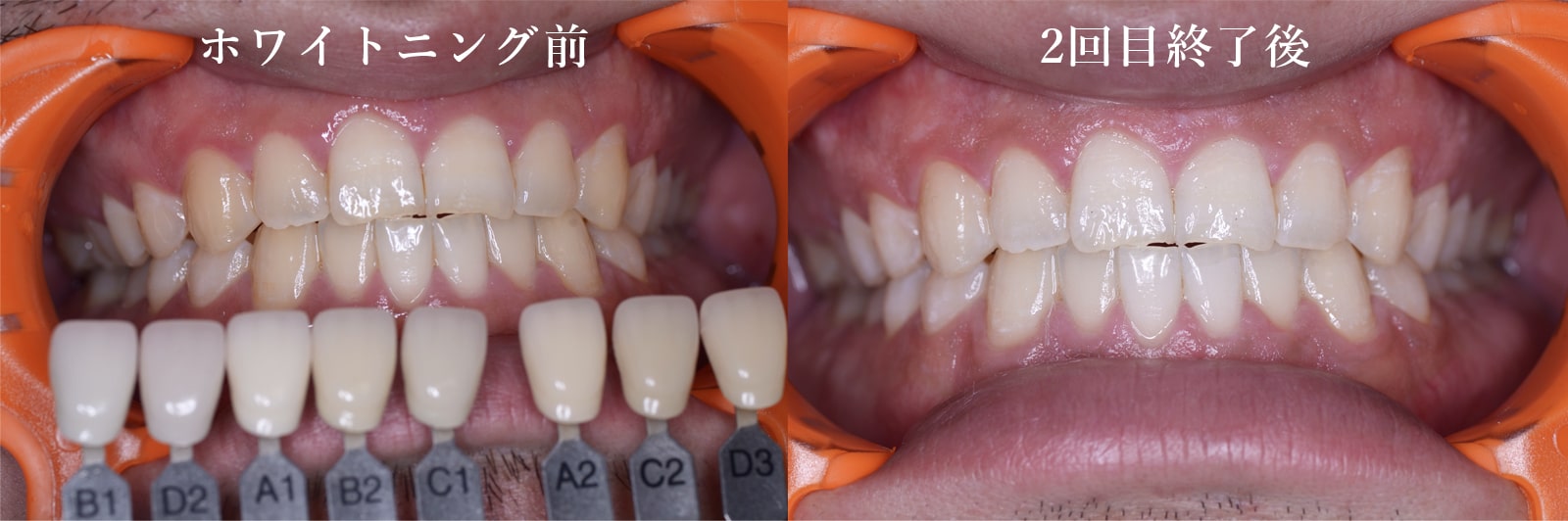 オフィスホワイトニングの症例