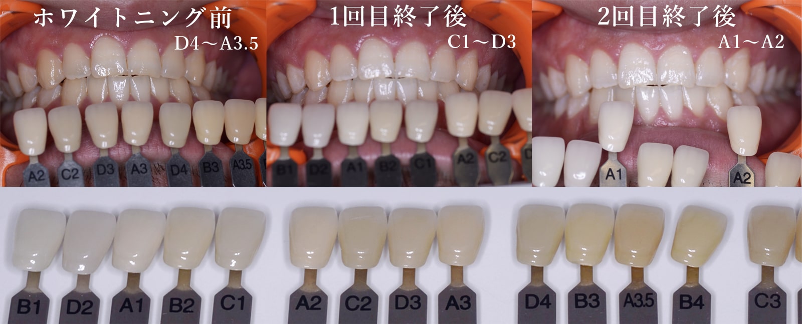 オフィスホワイトニングの症例